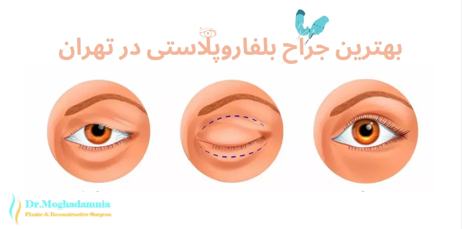 بهترین جراح بلفاروپلاستی در تهران