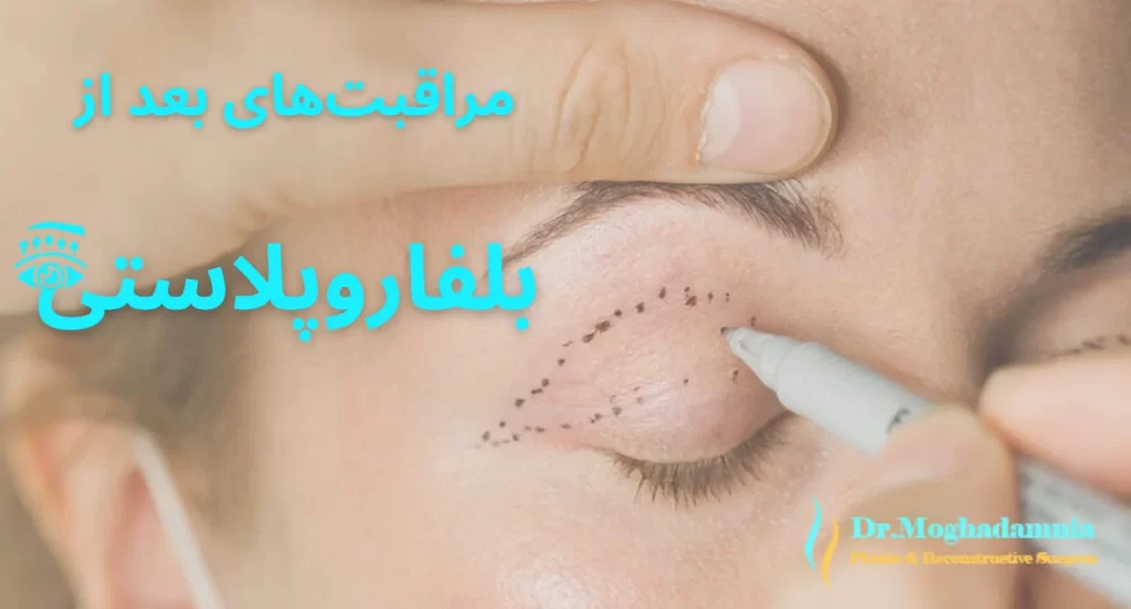 مراقبت‌های بعد از جراحی زیبایی پلک (بلفاروپلاستی)