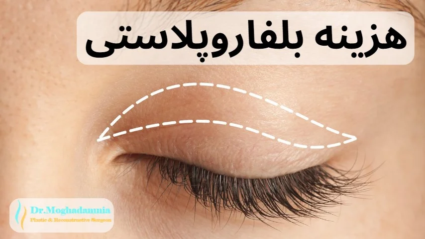 هزینه بلفاروپلاستی
